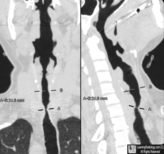 tracheal stenosis